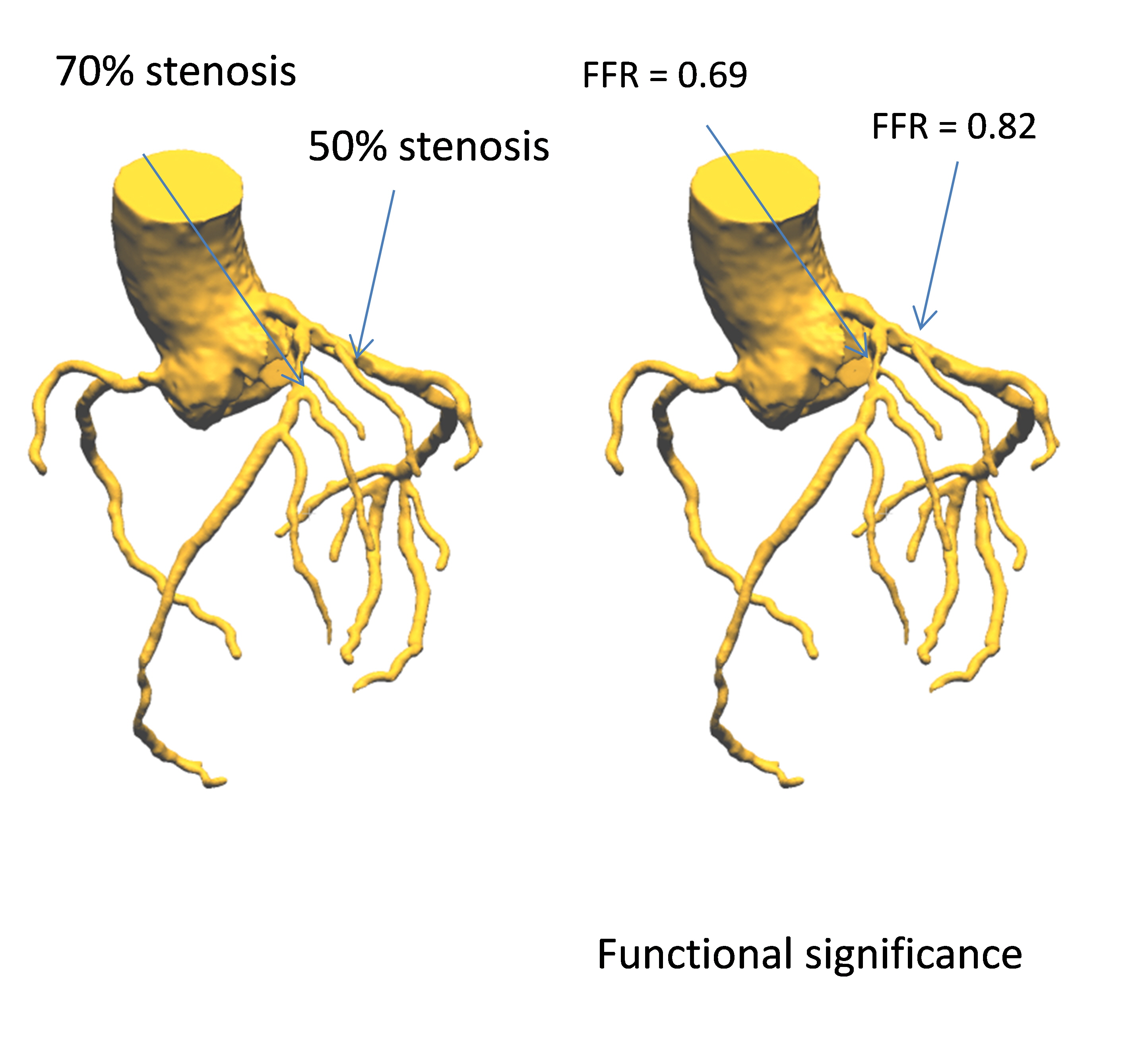 관상동맥질환 평가방법의 발전