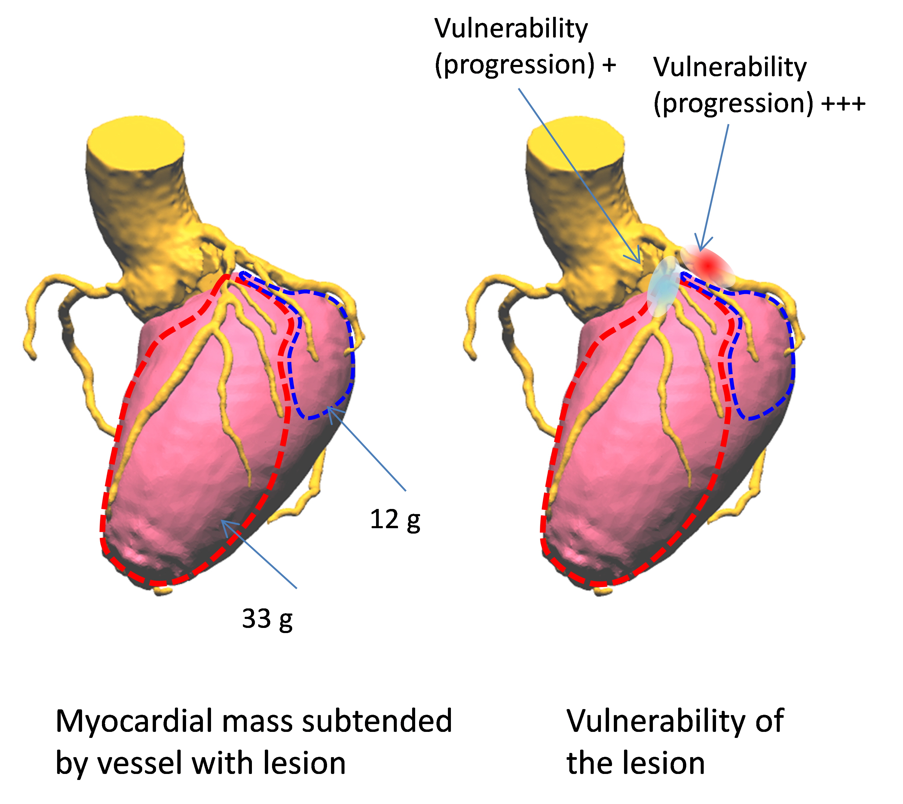 관상동맥질환 평가방법의 발전