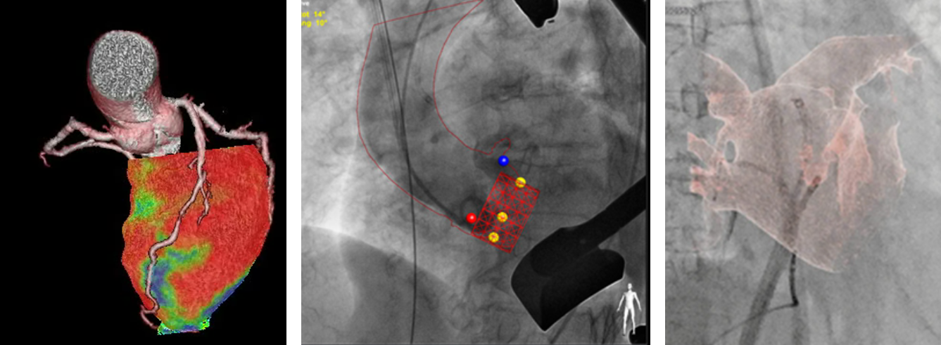 심장혈관질환 융합 이미징(Coronary artery tree and ischemic myocardial territory, planning of TAVI, CT as roadmap for live fluoroscopic image)